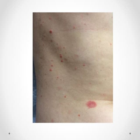 Pityriasis rosea
