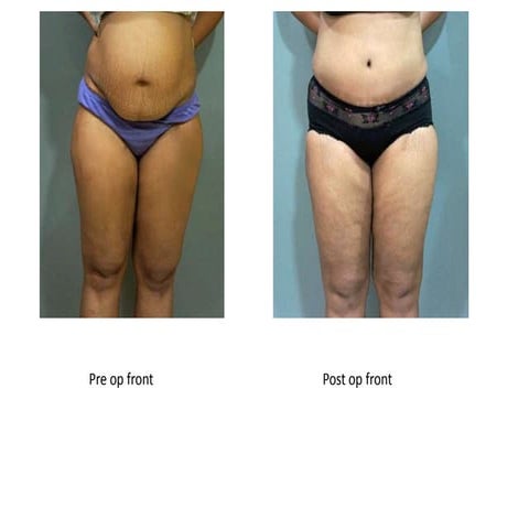 Pre And Post Pics Parul