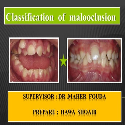 Classification  of  malooclusion 