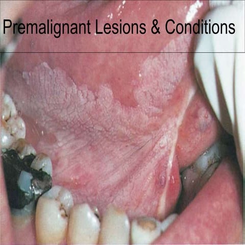 Premalignant-lesion-&-Condition-20207231010110.ppt