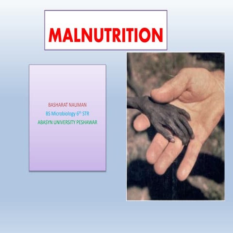 Malnutrition and its prevention.pptx