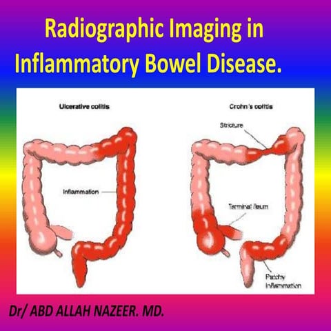 Presentation1.pptx. inflammatory bowel disease.