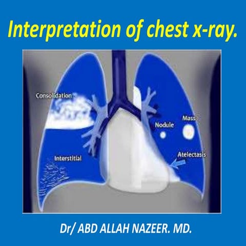 Presentation1.pptx. interpretation of x ray chest.