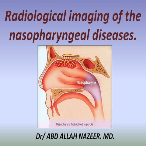 Presentation1.pptx, radiological imaging of the nasopharyngeal diseases.