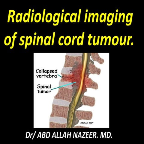 Presentation1.pptx, radiological imaging of spinal cord tumour.