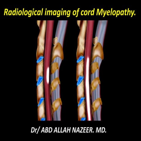 Myelopathy_Presentation..............pptx