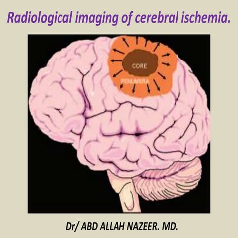 Presentation1.pptx, radiological imaging of cerebral ischemia.