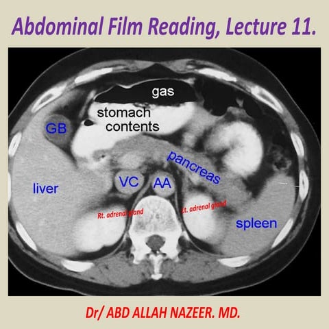 Presentation1.pptx, abdominal film reading, lecture 11.