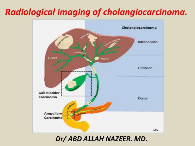Cholangiocarcinoma Cancer