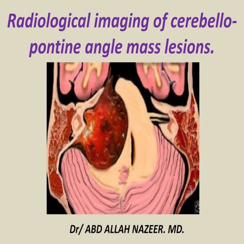 Presentation1.pptx, radiological imaging of cerebello pontine angle mass lesi...