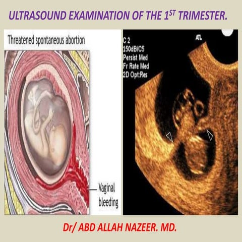 Presentation1.pptx, ultrasound examination of the 1st trimester pregnancy.