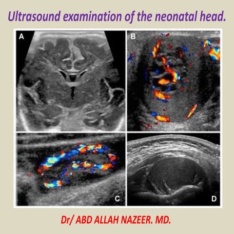 Presentation1.pptx, ultrasound examination of the neonatal head.