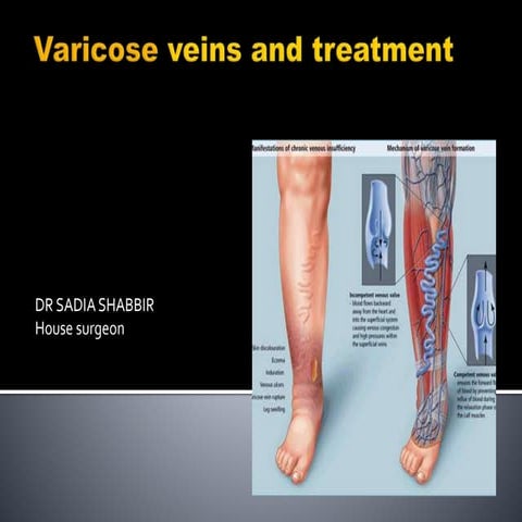 vericose veins