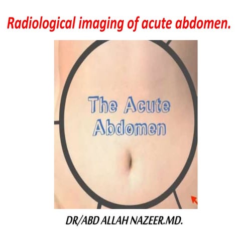 Presentation1.pptx acute abdomen.
