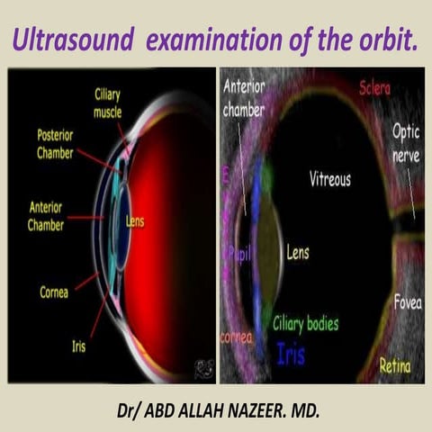 Presentation1.pptx, ultrasound examination of the orbit.