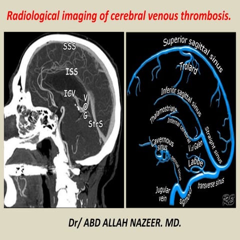Presentation1.pptx, radiological imaging of cerebral venous thrombosis.