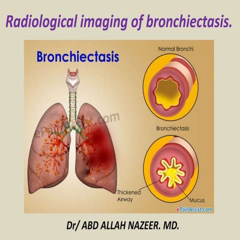 Presentation1.pptx, radiological imaging of bronchiectasis.