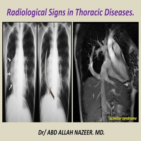 Presentation1.pptx, radiological signs in thoracic radiology.