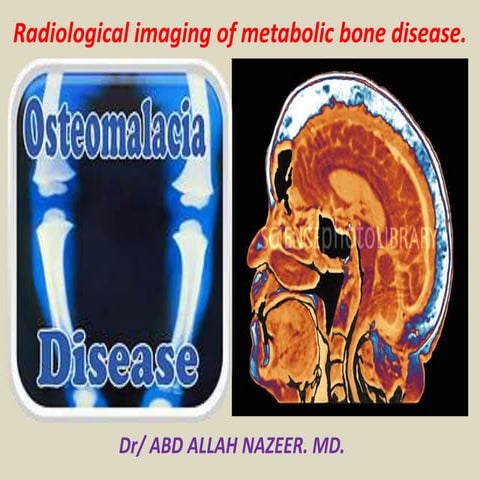 Presentation1.pptx, radiological imaging of metabolic bone diseases.