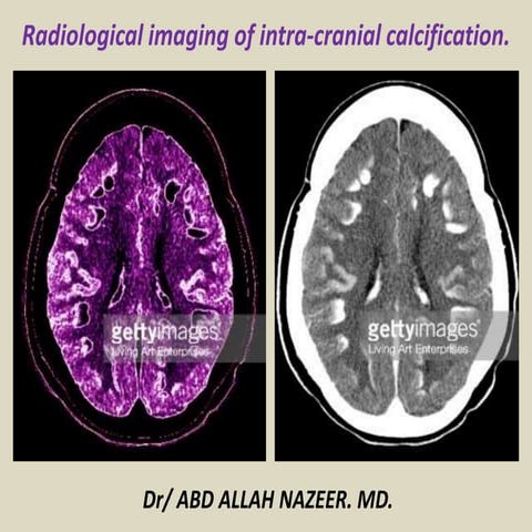 Presentation1.pptx, radiological imaging of intra cranial calcification.
