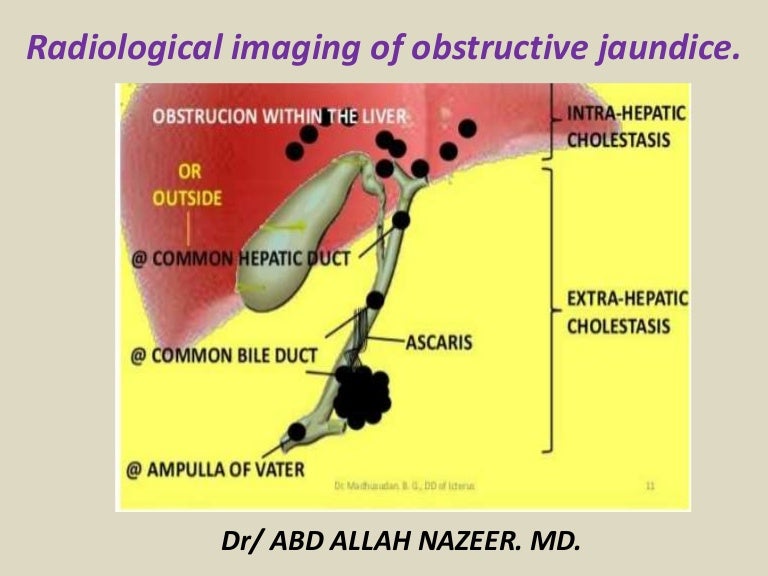 Causes Of Obstructive Jaundice Obstructive jaundice 19_9_2014