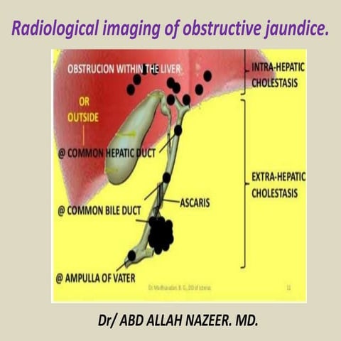Presentation1.pptx, radiological imaging of obstructive jaundice.