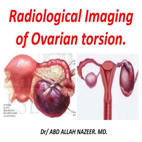 Presentation11, radiological imaging of ovarian torsion.