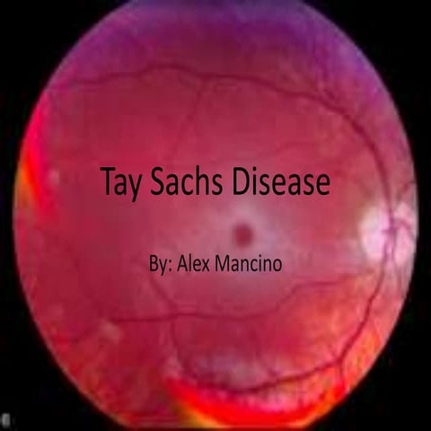 Tay Sachs Disease