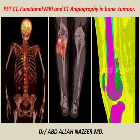 Presentation1, pet ct, functional mri and ct angiography in bone tumour ...