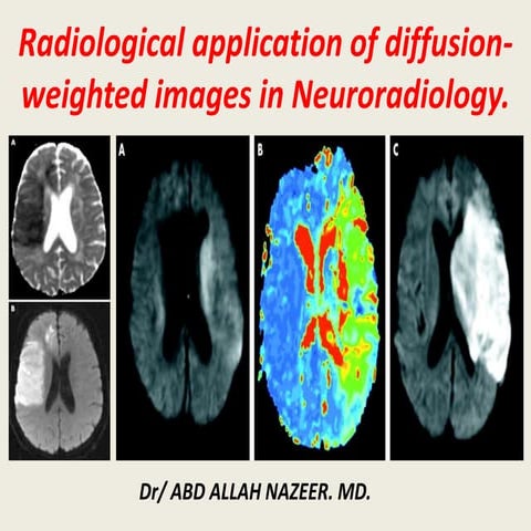 Presentation1, radiological application of diffusion weighted imges in neuror...