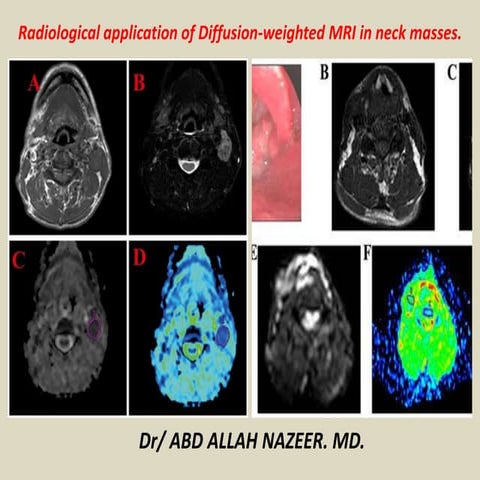 Presentation1, radiological application of diffusion weighted mri in neck mas...