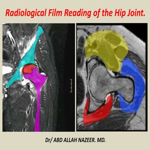 Presentation1, radiological film reading of the hip joint. | PPTX