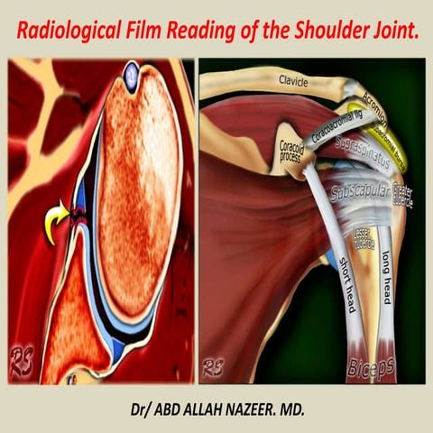 Presentation1, radiological film reading of the sholder joint. | PPTX