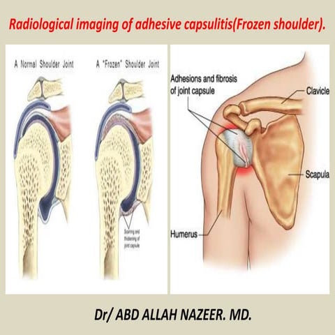 Presentation1, radiological imaging of adhesive capsulitis(frozen shoulder).