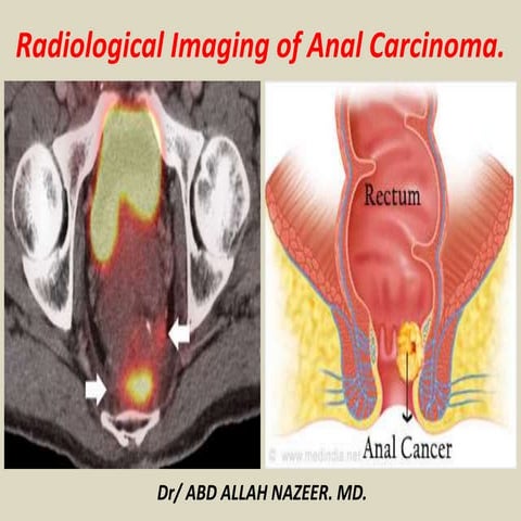Presentation1, radiological imaging of anal carcinoma.
