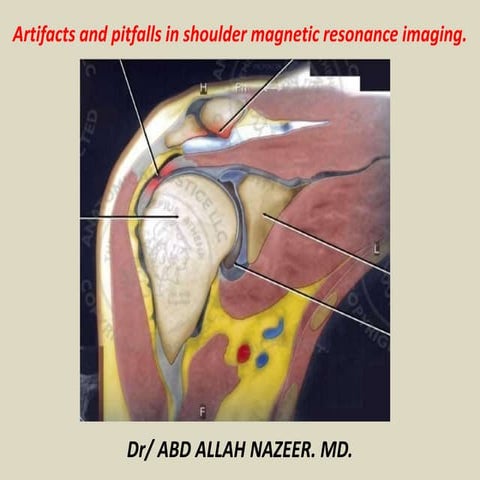 Presentation1, radiological imaging of artifact and pitfalls in shoulder join...