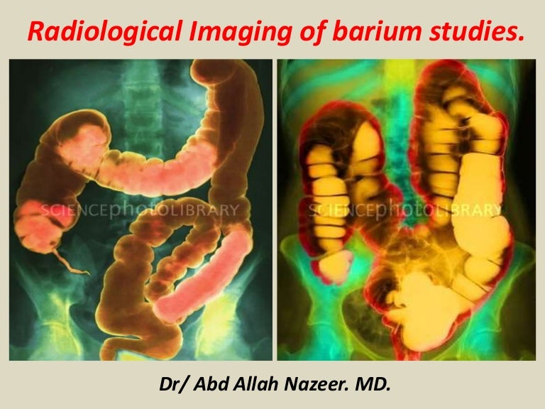 Presentation1, radiological imaging of barium studies.