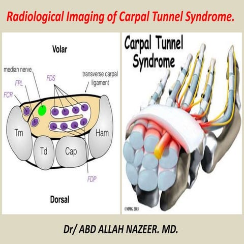 Presentation1 radiological imaging of carpal tunnel syndrome.