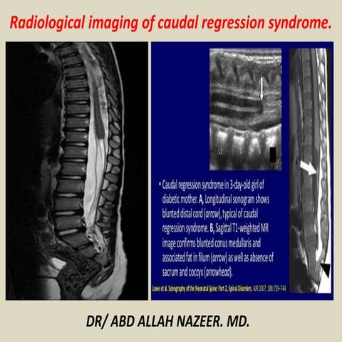 Presentation1, radiological imaging of caudal regression syndrome.