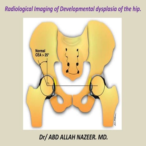 Presentation1, radiological imaging of developmental dysplasia of the hip joint.