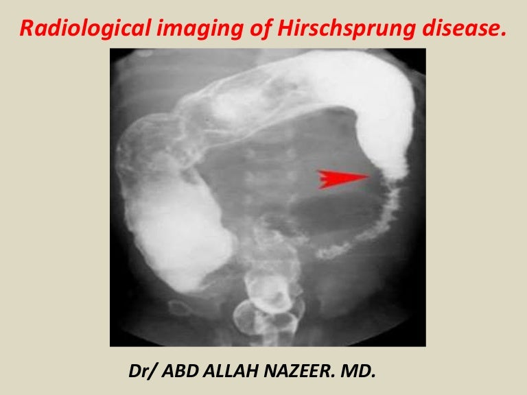 Presentation1, radiological imaging of hirshsprung disease.