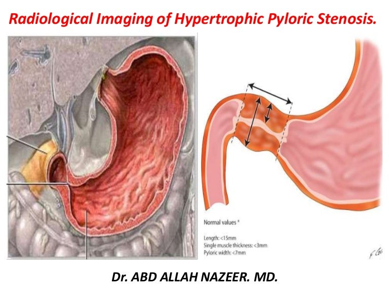 pyloric stenoisis adults after surgery