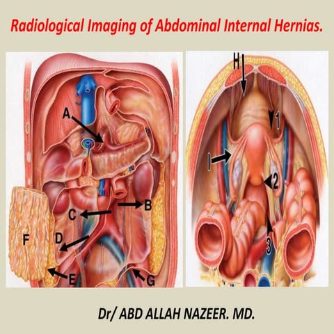 Presentation1, radiological imaging of internal abdominal hernia.