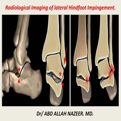 Presentation1, radiological imaging of lateral hindfoot impingement.