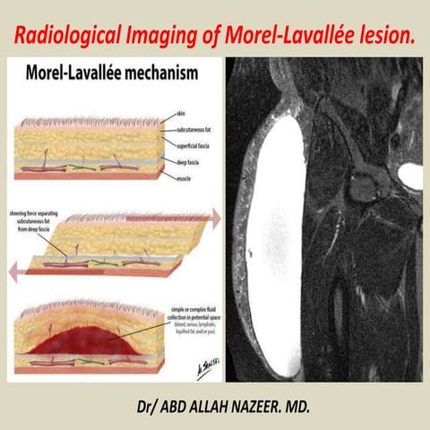 Presentation1, radiological imaging of morel lavallee lesion.