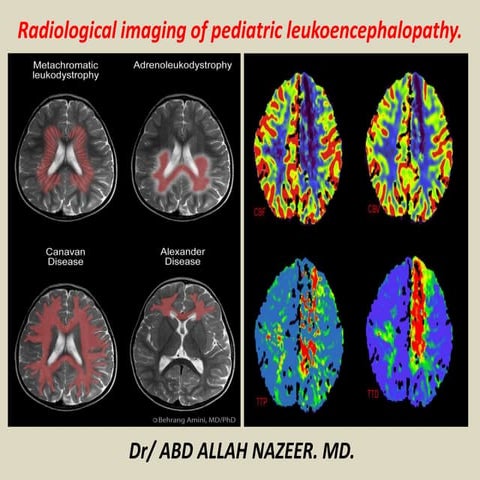Presentation1, radiological imaging of pediatric leukodystrophy.