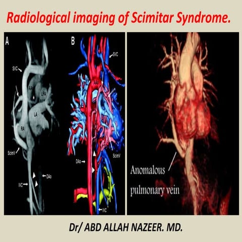 Presentation1, radiological imaging of scimitar syndrome