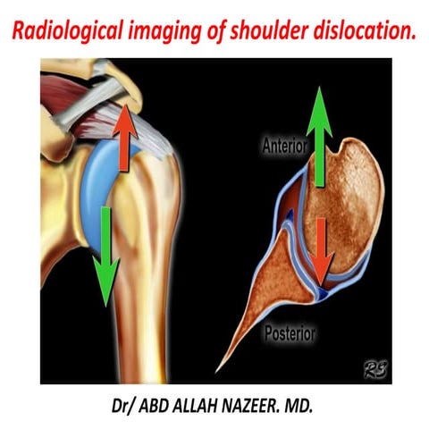 Presentation1, radiological imaging of shoulder dislocation.