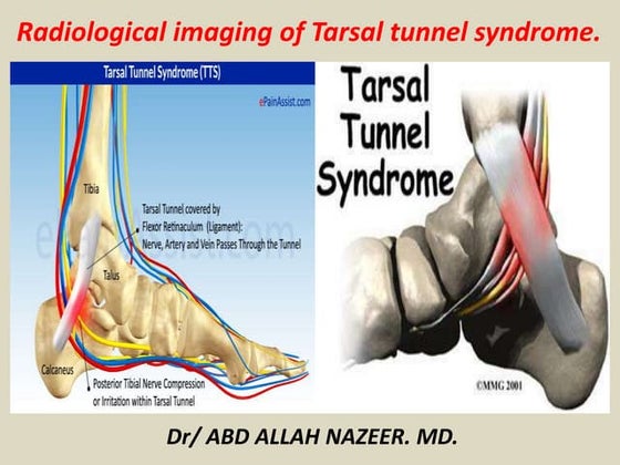 Tarsal Tunnel Incision | PPT