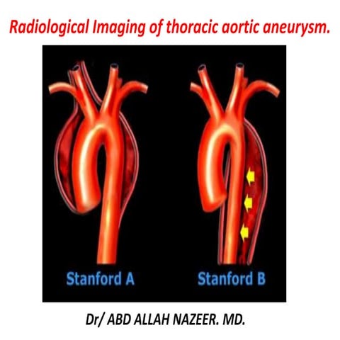 Presentation1, radiological imaging of thoracic aortic aneurysm.